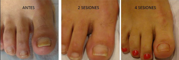 Segunda sesión onicomicosis