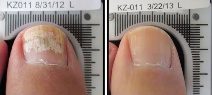 Tratamiento onicomicosis