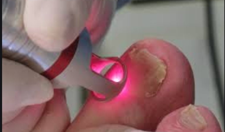 Onicomicosis